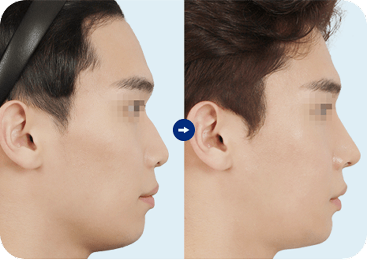 id Hospital - Male Rhinoplasty - Hump Nose and Deviated Septum Correction