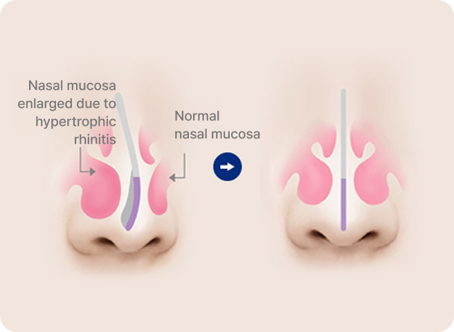 id Hospital - Male Rhinoplasty - Hypertrophic Rhinitis