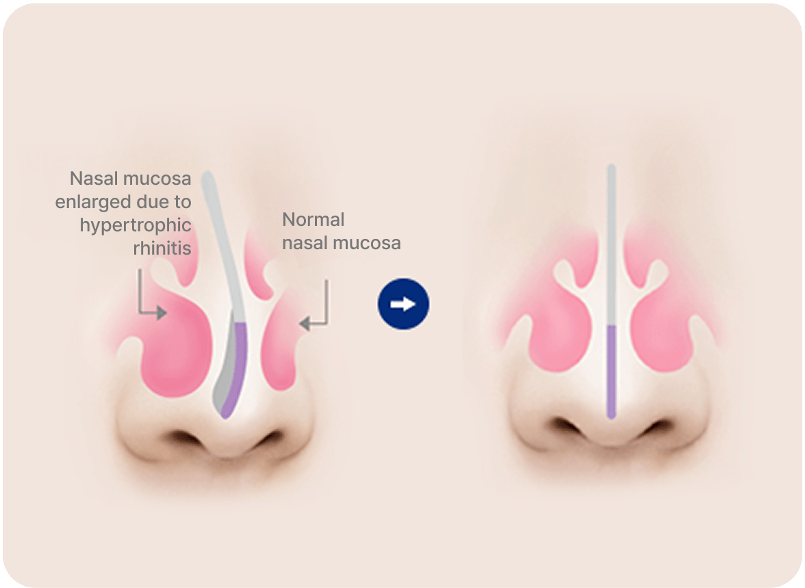 id Hospital - Male Rhinoplasty - Hypertrophic Rhinitis
