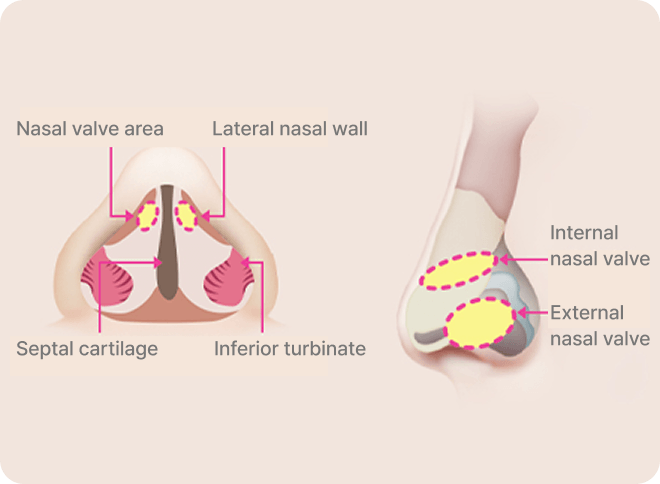 id Hospital - Male Rhinoplasty - Nasal Valve Stenosis