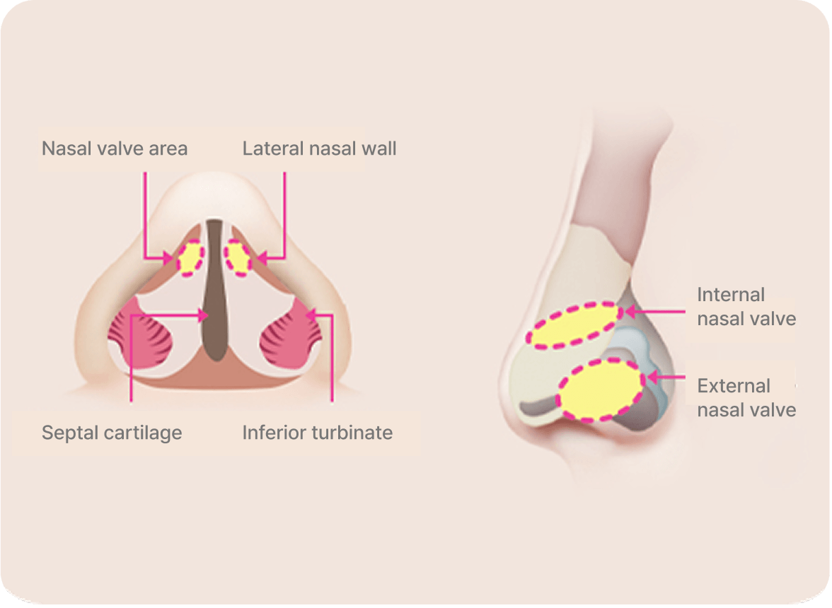 id Hospital - Male Rhinoplasty - Nasal Valve Stenosis
