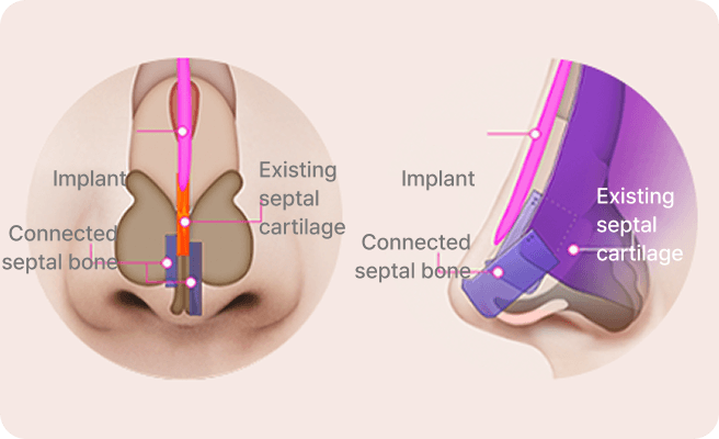 id Hospital - Male Rhinoplasty - Three-Stage Serial Extension Technique