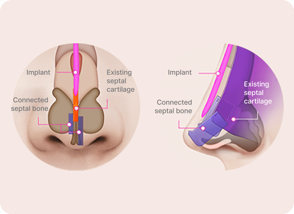 id Hospital - Male Rhinoplasty - Three-Stage Serial Extension Technique
