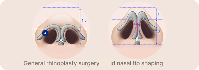 id Hospital - Male Rhinoplasty - Cosmetic Rhinoplasty