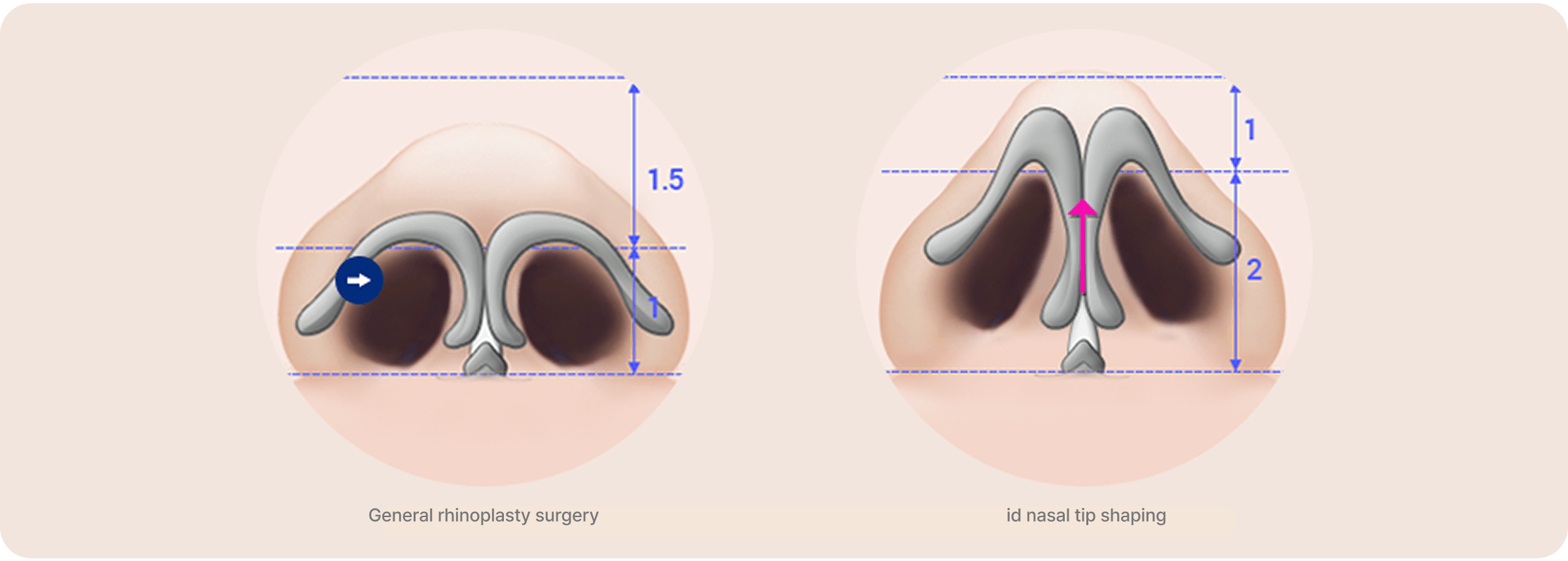 id Hospital - Male Rhinoplasty - Cosmetic Rhinoplasty