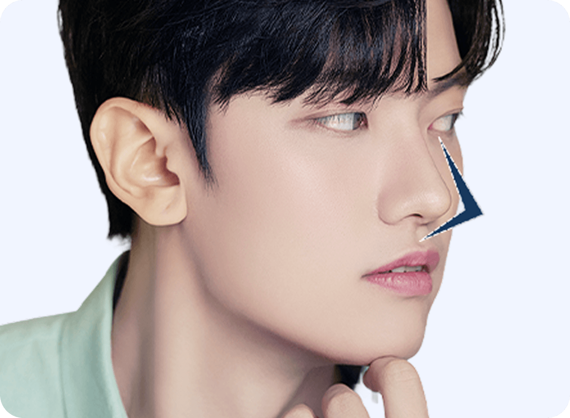 id Hospital - Male Rhinoplasty - Straight Nasal Bridge Line at 70 Degree Angle