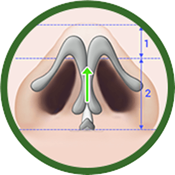 id Hospital - Alar Reduction - Improved Nostril Proportion After