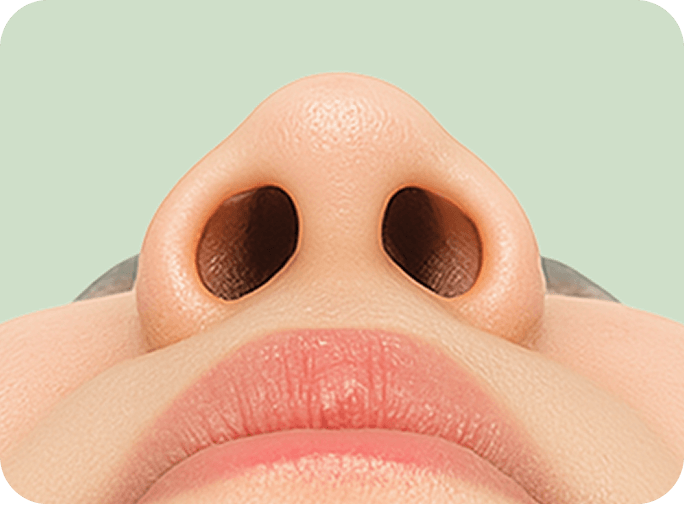 id Hospital - Alar Reduction - Blunt Nose Analysis