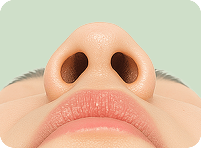 id Hospital - Alar Reduction - Bulbous Tip Analysis