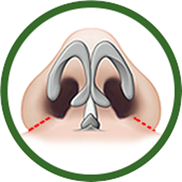 id Hospital - Alar Reduction - Alar Resection After