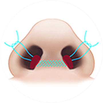 id Hospital - Alar Reduction - Nostril Suturing Before