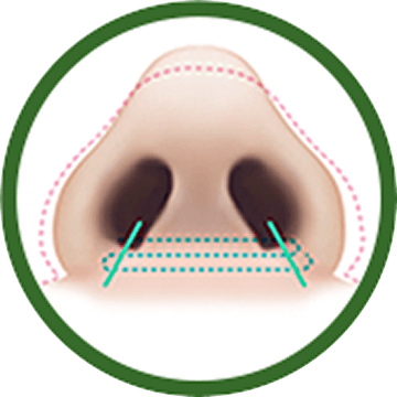 id Hospital - Alar Reduction - Nostril Suturing After