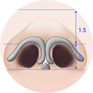 id Hospital - Alar Reduction - Alar Shaping Before