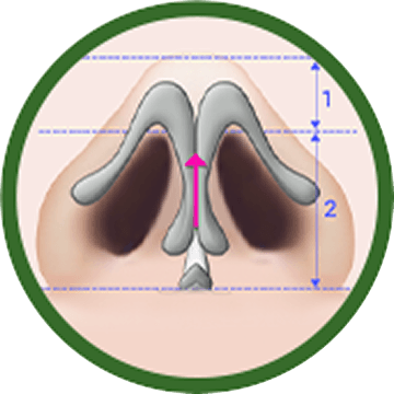 id Hospital - Alar Reduction - Alar Shaping After