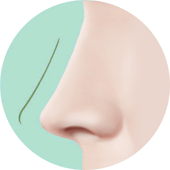 id Hospital - Asian Rhinoplasty - Surgical Technique Step 1