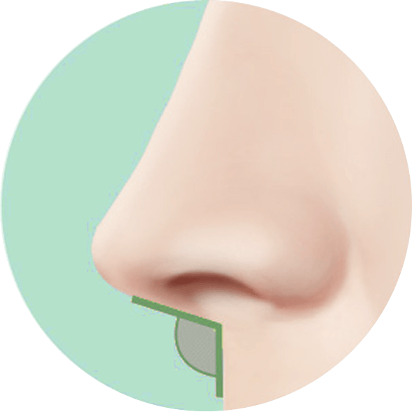 id Hospital - Asian Rhinoplasty - Surgical Technique Step 2