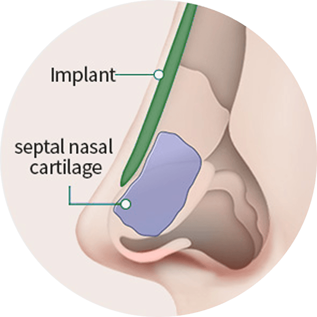 id Hospital - Asian Rhinoplasty - Generic Rhinoplasty Technique