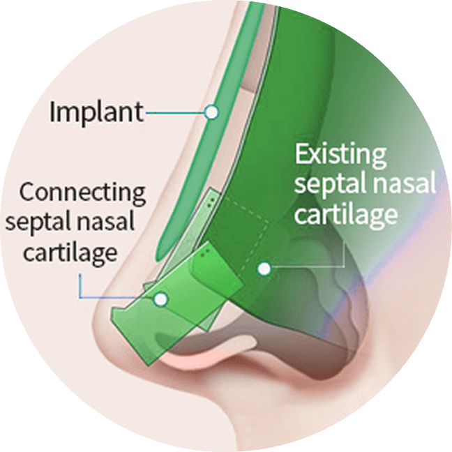 id Hospital - Asian Rhinoplasty - 3-Series Lengthening Technique