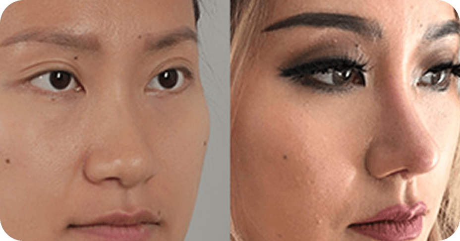 id Hospital - Asian Rhinoplasty - 3-Series Lengthening for Asian Nose