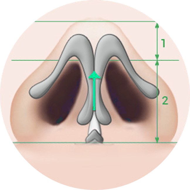 id Hospital - Asian Rhinoplasty - id Nose Tip Shaving Technique