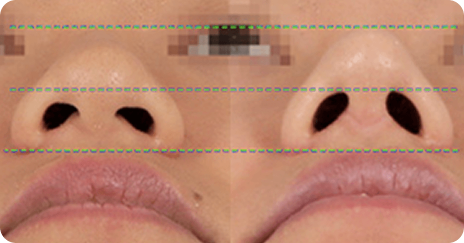 id Hospital - Asian Rhinoplasty - id Tip Shaving for Asian Nose Shape