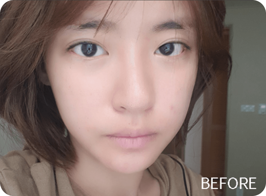 id Hospital - Asian Rhinoplasty - Recovery Diary Before