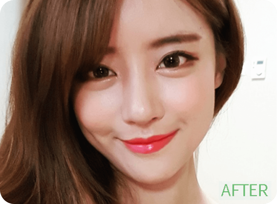 id Hospital - Asian Rhinoplasty - Recovery Diary After
