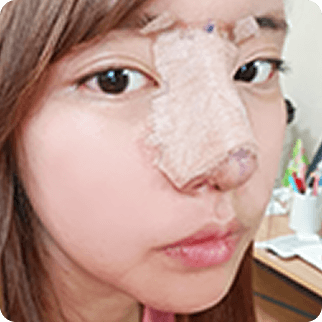 id Hospital - Asian Rhinoplasty - Day of surgery Before