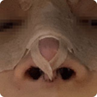 id Hospital - Asian Rhinoplasty - Day of surgery After