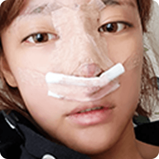 id Hospital - Asian Rhinoplasty - Treatment after 2~3 days Before