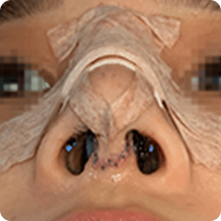 id Hospital - Asian Rhinoplasty - Treatment after 2~3 days After