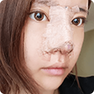 id Hospital - Asian Rhinoplasty - Treatment after 7 days Before
