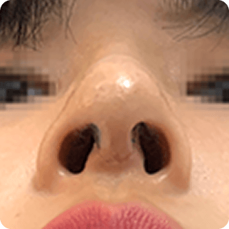 id Hospital - Asian Rhinoplasty - Treatment after 7 days After