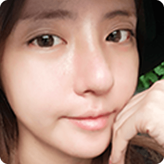 id Hospital - Asian Rhinoplasty - After 7 days Before