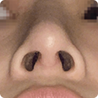 id Hospital - Asian Rhinoplasty - After 7 days After