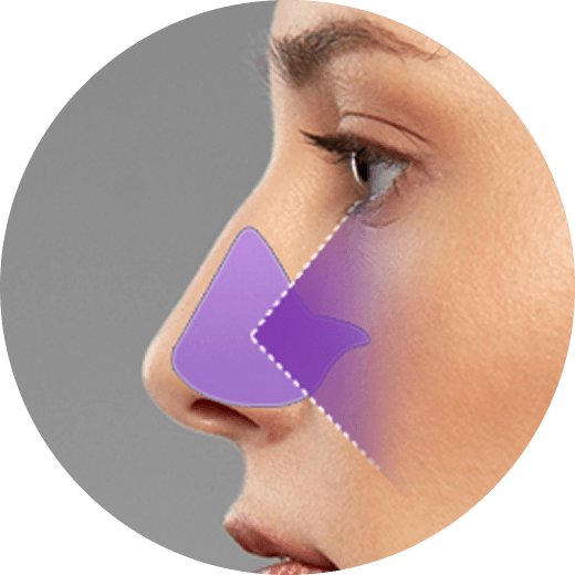 id Hospital - No-Implant Nose - Septal Cartilage