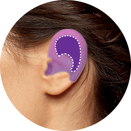 id Hospital - No-Implant Nose - Ear Cartilage