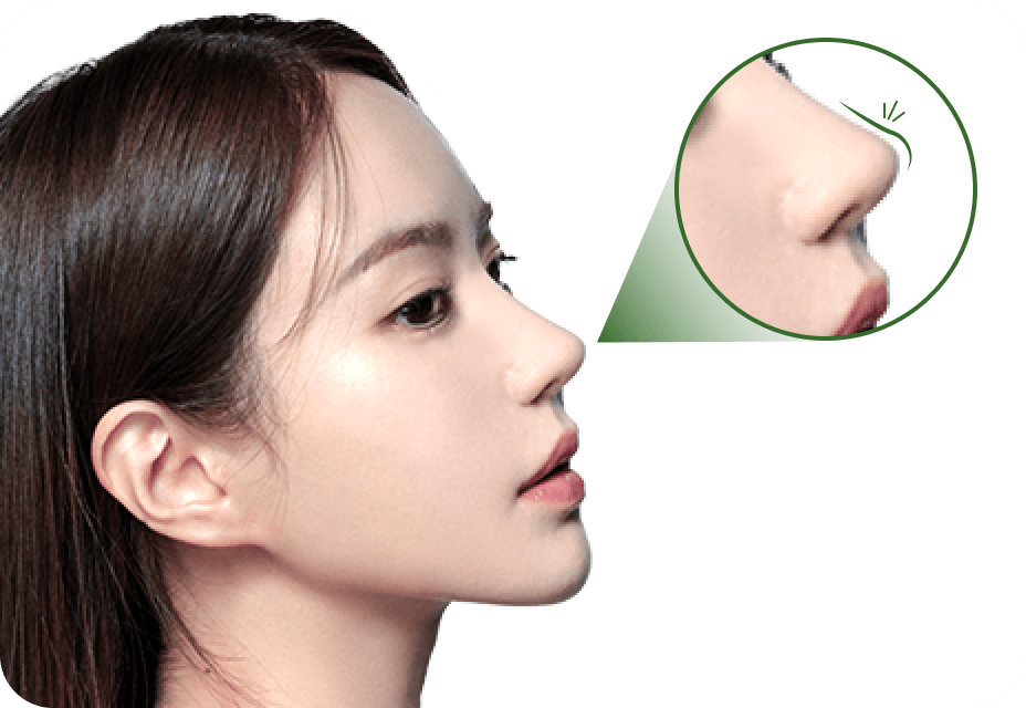 id Hospital - No-Implant Nose - Customized Nasal Line with Cartilage