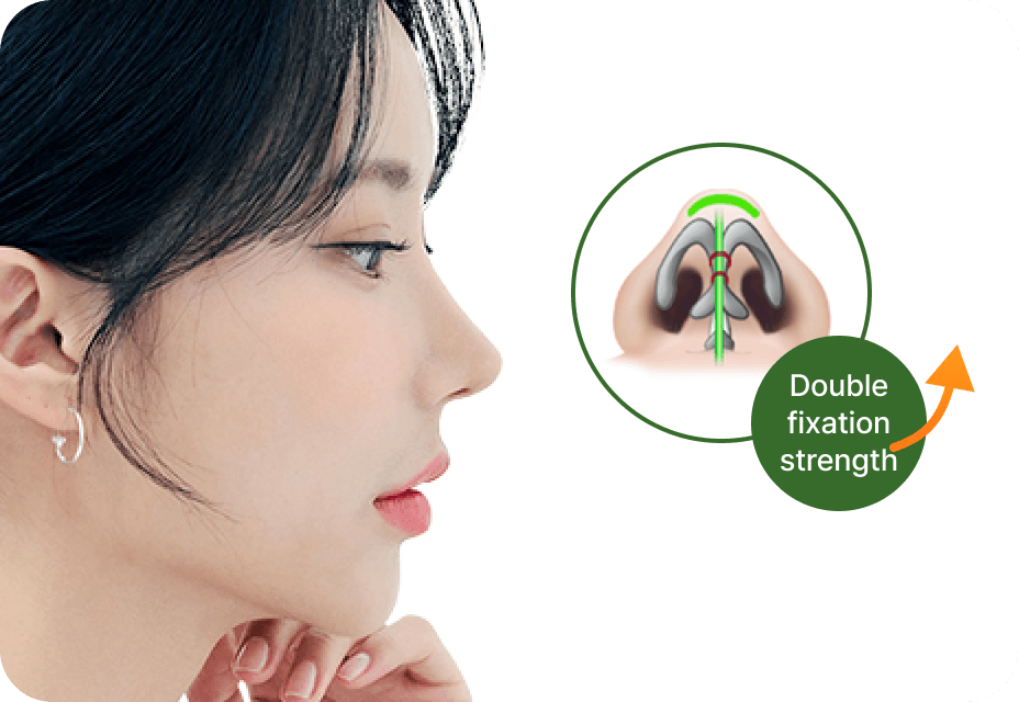 id Hospital - No-Implant Nose - id Double Wing Binding Technique