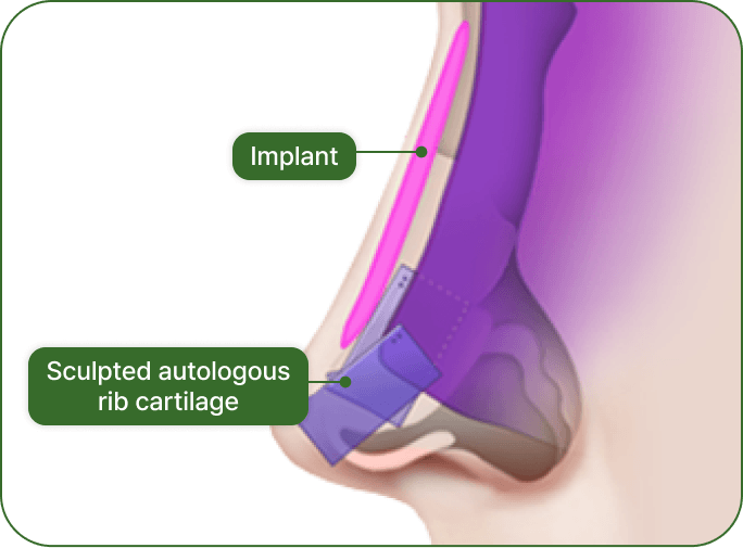 id Hospital - No-Implant Nose - Designing Rib Cartilage Grafts