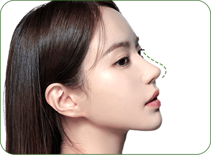 id Hospital - No-Implant Nose - Creating a Natural Nasal Line