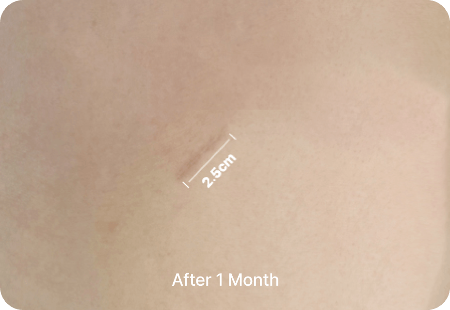 id Hospital - No-Implant Nose - Rib Cartilage Incision After 1 Month