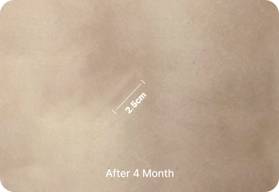 id Hospital - No-Implant Nose - Rib Cartilage Incision After 4 Months