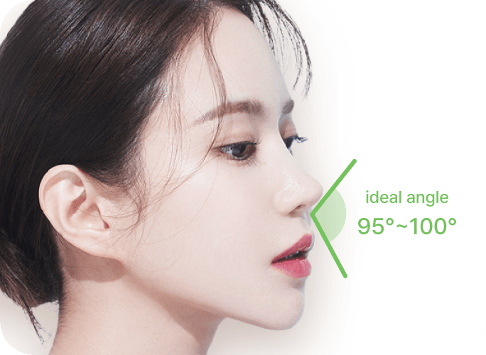 id Hospital - Rhinoplasty - Natural Nasolabial Line