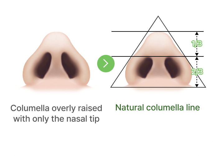 id Hospital - Rhinoplasty - Natural Line Columella