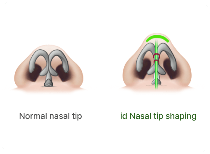 id Hospital - Rhinoplasty - Glamorous Nose Tip