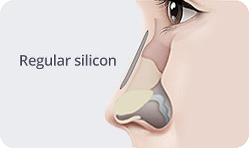 id Hospital - Rhinoplasty - Regular Silicone Nose Surgery