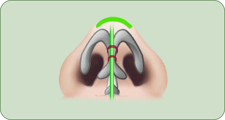 id Hospital - Rhinoplasty - Barbie Line Step 1