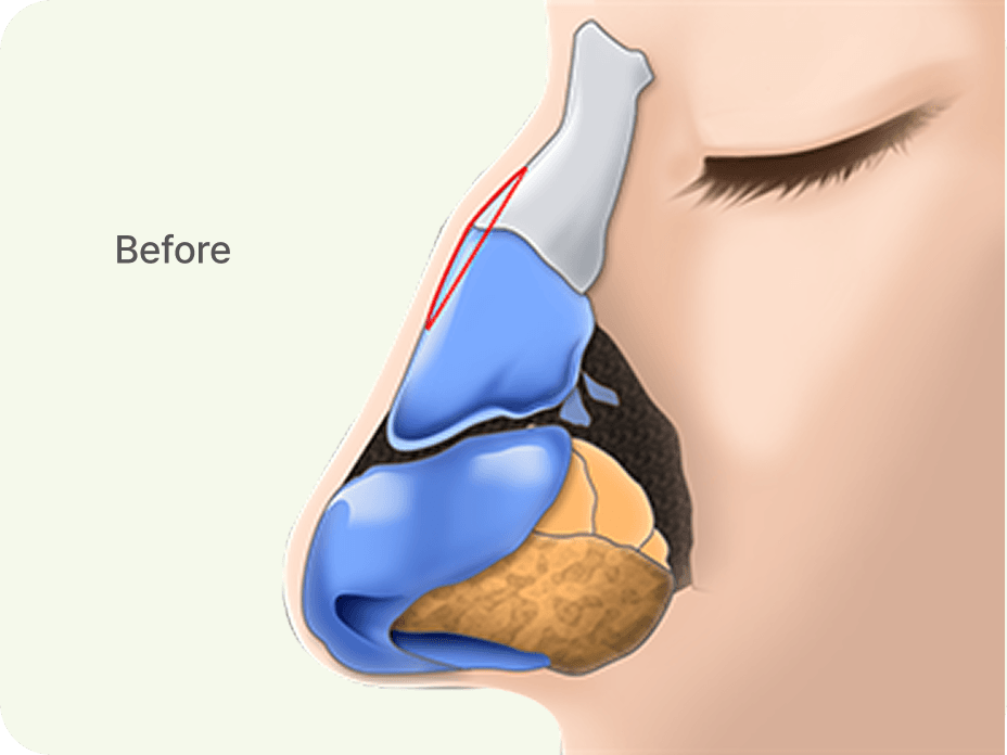 id Hospital - Rhinoplasty - Nose with a Small Hump Before