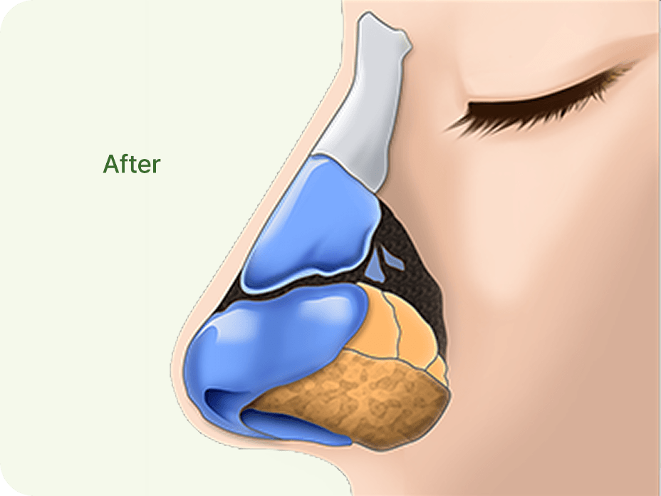 id Hospital - Rhinoplasty - Nose with a Small Hump After